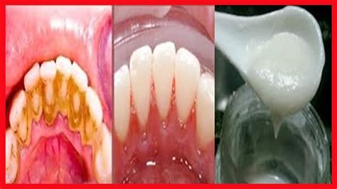 Como Tirar Tartaro Dos Dentes E Clarear Os Dentes Em Minutos How To