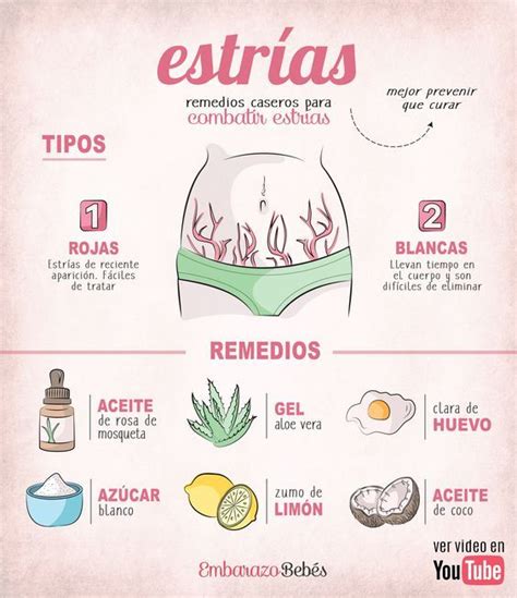 Infografía cómo evitar las estrías en el embarazo Consejos para