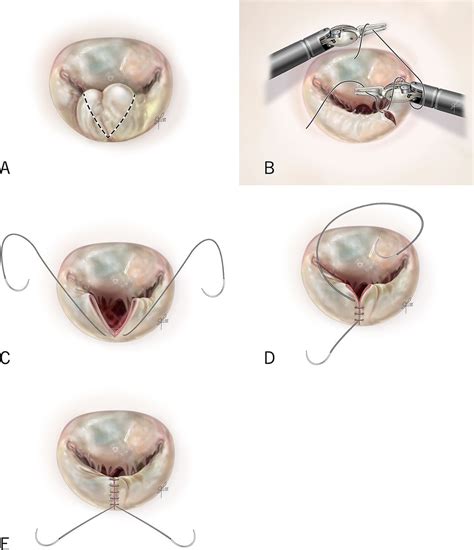 Minimally Invasive Mitral Valve Repair | The Best Porn Website