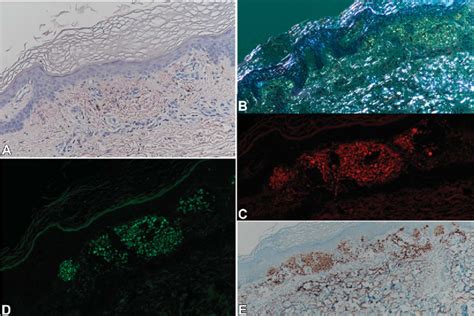 Case With Cutaneous Amyloidosis A Congo Red Positivity B Download Scientific Diagram