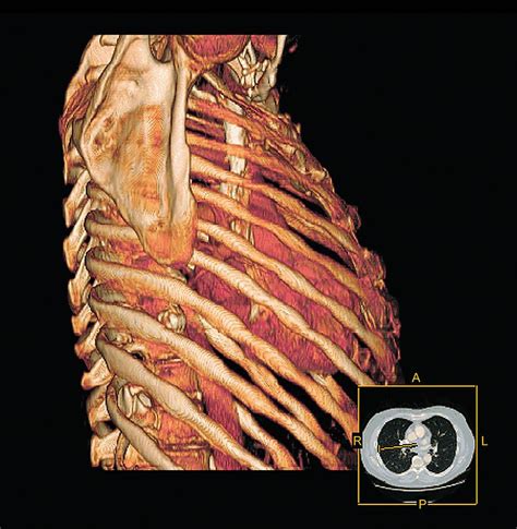 Ribcage And Heart 3d Ct Scan Photograph By Miriam Maslo Fine Art America