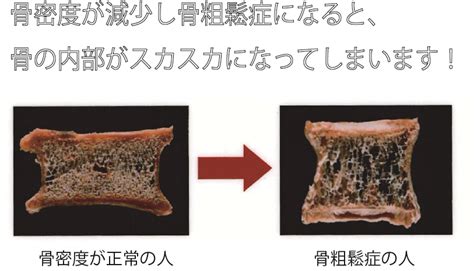 今からできる！骨粗鬆症にならないために骨を強くする3つの対策 株式会社メディケアー