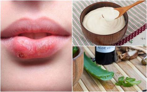 7 Effective Home Remedies For Cold Sores Daily Health Valley