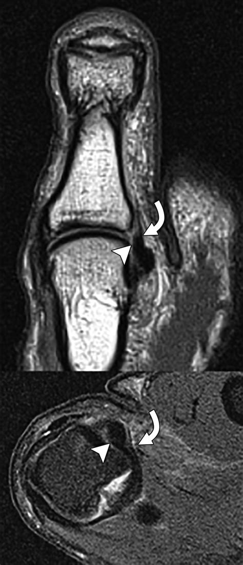 Mri Of The Fingers An Update Ajr