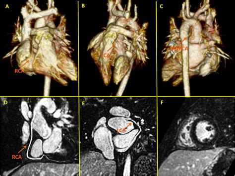 Frontiers 3d Whole Heart Imaging For Congenital Heart Disease