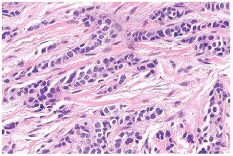 Invasive Lobular Carcinoma Image