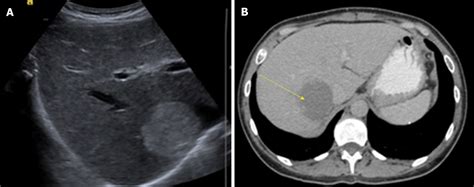 Are Liver Hemangiomas Dangerous