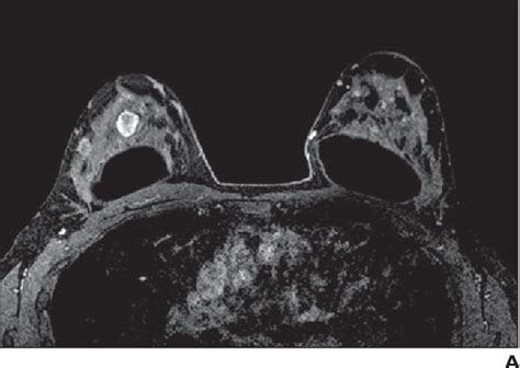 Figure 1—43 From Assessment Of Breast Lesions With Diffusion Weighted