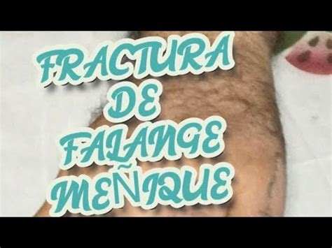 Fractura De Me Ique Retir Y Colocaci N De Ferula Aplicando Suelda