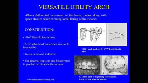 Versatile Utility Arch Fixed Orthodontic Courses By Indian Dental