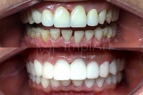 Lente Contato Dental Antes E Depois 50kb ImplArt