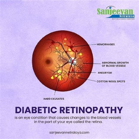 Best Diabetic Retinopathy Treatment In India By Sanjeevan Netralaya