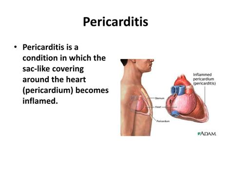 Ppt Pericardial Diseases Powerpoint Presentation Free Download Id