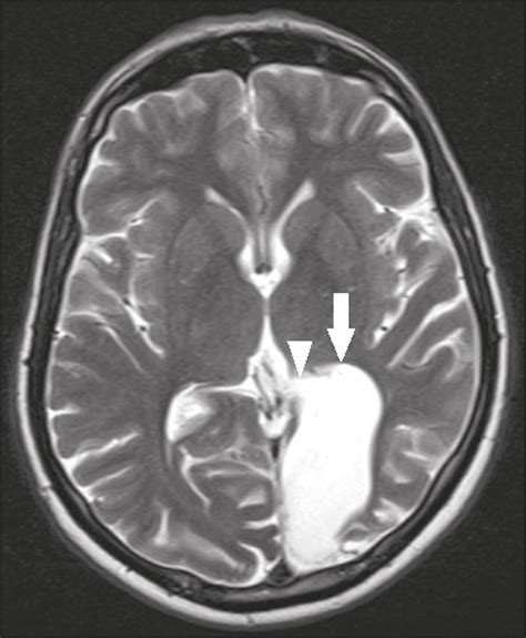 Porencephalic Cyst Mri