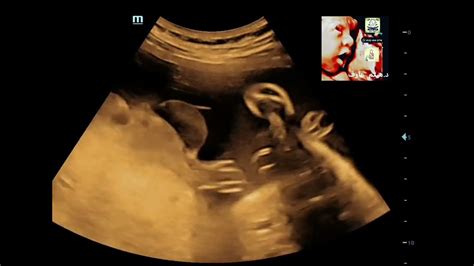 Sub Amniotic Hematoma Fetal Ultrasound By Dr Haissam Aref Dms Msc Md Ultrasound Youtube