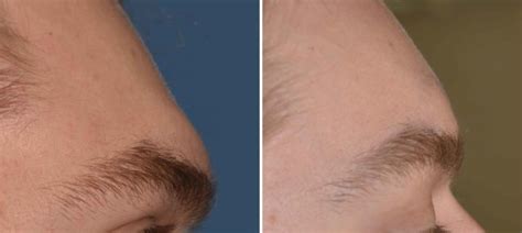 Male Brow Bone Reduction Immediate Result Side View Dr Barry Eppley Indianapolis Explore