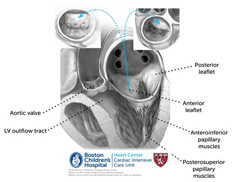 Mitral Valve Pathologies Online Supplement