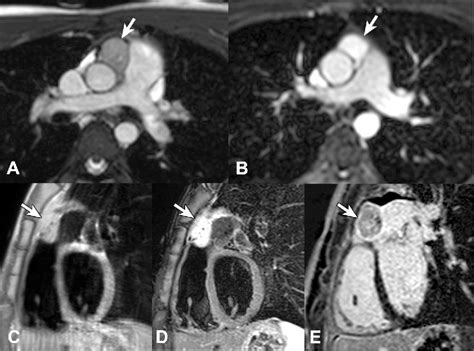 Figure 1 From Images In Cardiovascular Medicine Cardiac Paraganglioma