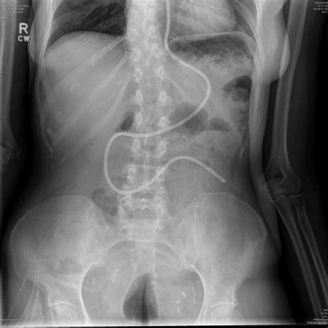 Su Nasojejunal Feeding Tube Placement Technique Utilizing Through