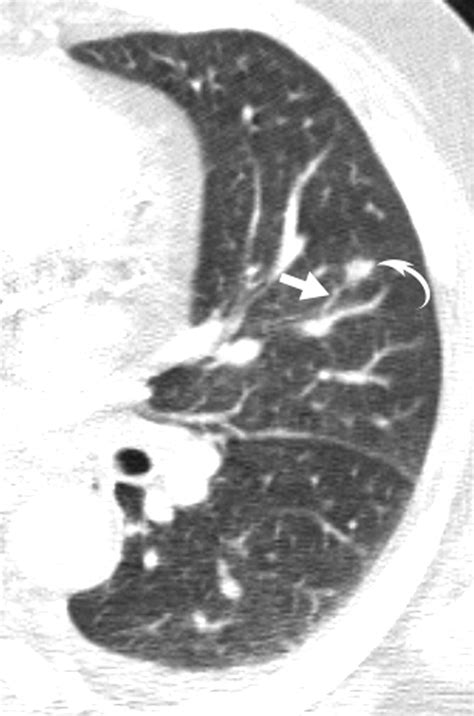 High Resolution Mdct Of Pulmonary Septic Embolism Evaluation Of The Feeding Vessel Sign Ajr