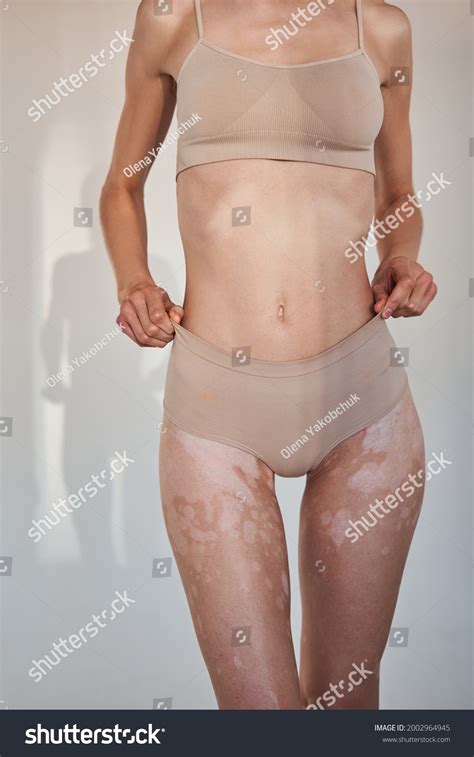 Naked Woman Showing Nude Body Vitiligo Stock Photo 2002964945 Shutterstock