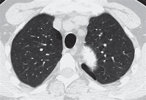 Marfan Syndrome Lungs