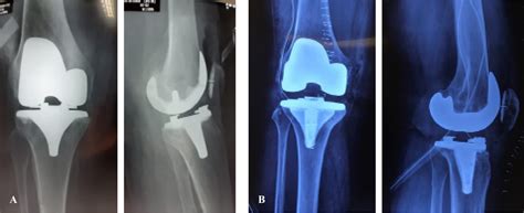 Functional Assessment In Total Knee Arthroplasty Comparing The