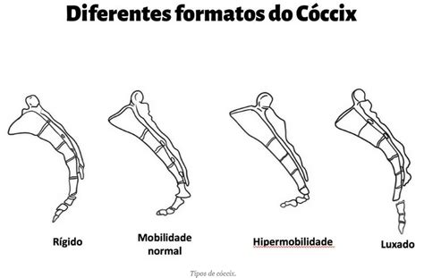 Fratura No Cóccix Causas Sintomas E Opções De Tratamento