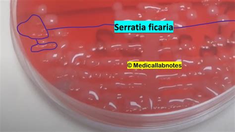 Serratia Archives - Medical Notes