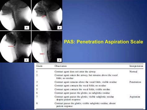 Aspiration Pneumonia In Head And Neck Cancer Patients Ppt