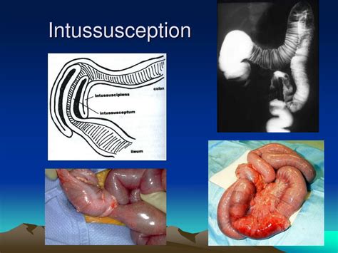 Ppt Bowel Obstruction Infants And Children Powerpoint Presentation