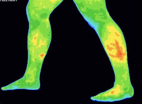 Thermography Upper Cervical Chiropractic Of Tulsa