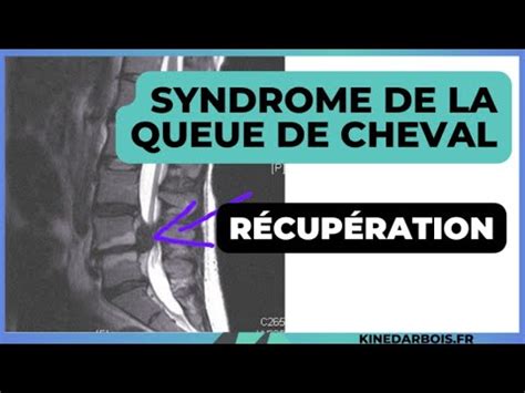 Syndrome De La Queue De Cheval Infos Kin Youtube