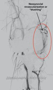 Geniculate Embolization For Arthritis And Following Knee Replacement