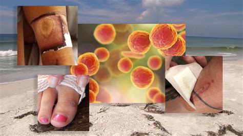 More Cases Of Flesh Eating Bacteria Reported In Florida Fox 35 Orlando