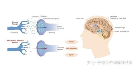 帕金森病的遗传检测 知乎