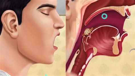 Asmr Tongue Cancer Treatment Of Tongue Cancer Surgery Animation