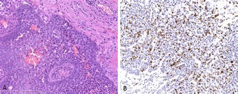 Histological Examination The Histological Section Shows Palisaded