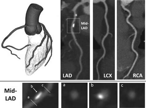 Coronary Computed Tomographic Angiography Circulation