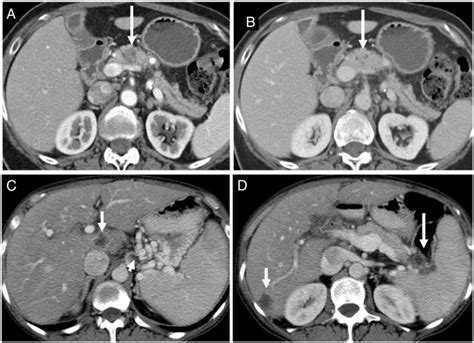 Imaging Of Pancreatic Cancer What The Surgeon Wants To Know Clinical