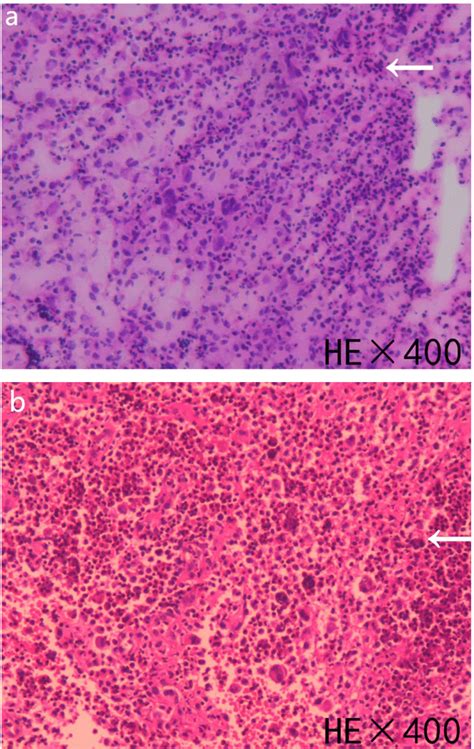 A B Postoperative Pathology Indicated Massive Langerhans Cell