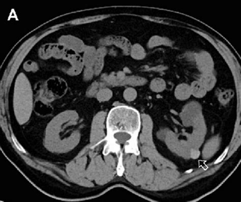 A In A 62 Year Old Male Patient Hyperdense Cyst In The Left Kidney
