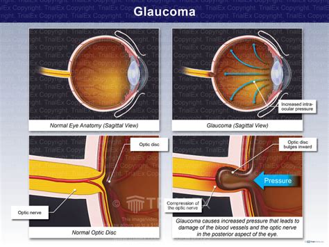 Glaucoma Trialexhibits Inc