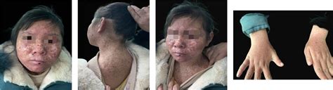 Frontiers Case Report Xeroderma Pigmentosum Group A With