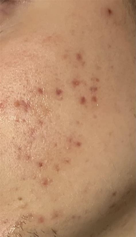 Acne Post Acne Marks Rskincareaddicts