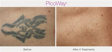 Laser Tattoo Removal Om Laser Wellness