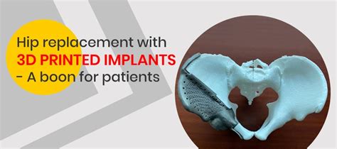 Hip Replacement With 3d Printed Implants A Boon For Patients 3dincredible