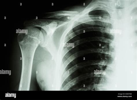 Clavicle Hi Res Stock Photography And Images Alamy