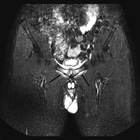 X Rays Of Osteitis Pubis In Two Patients Treated Conservatively