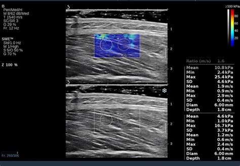 Comment On Muscle Involvement In Systemic Lupus Erythematosus